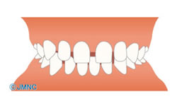 空隙歯列