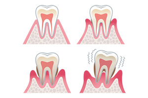 歯周病とは