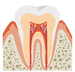 根管治療とは