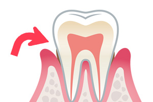 歯周病の状態と各々の治療法