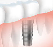 国産インプラント